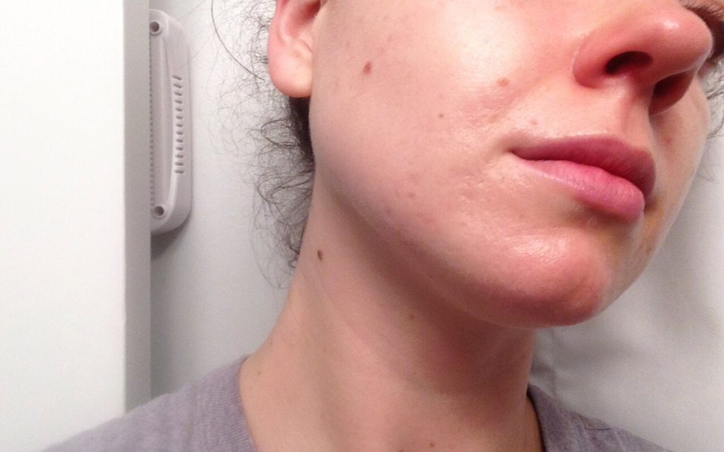 Acne prone skin before using cannabis beauty products