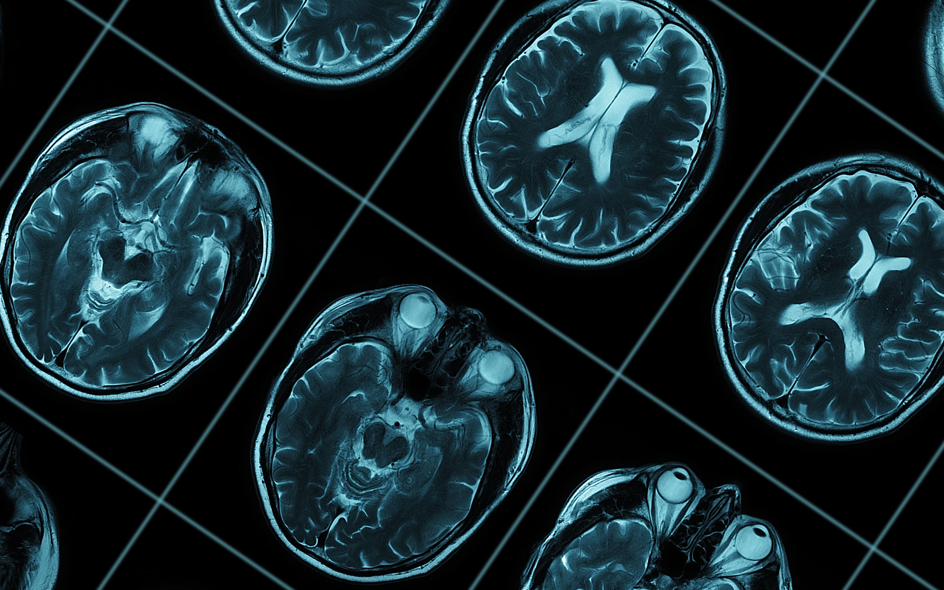 brain xray